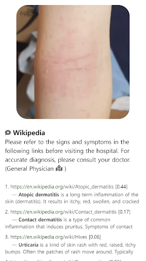 Model Dermatol ڈاؤن لوڈ کریں – جلد کی بیماریوں کی تشخیص ایپ - Screenshot 13
